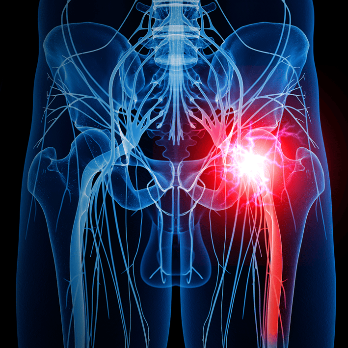 Sciatic nerve pain