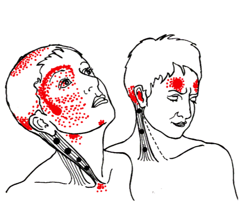 Self-Care of Trigger Points and Referral Patterns